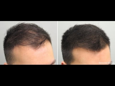 how to regrow hair widows peak